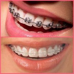 braces and Invisalign